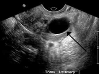 Ovarian Cysts - Cysts on Ovary - Polycystic Ovary